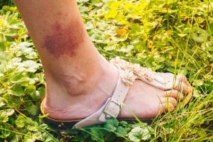 lyme-disease-understanding-the-basics-of-a-complex-infection